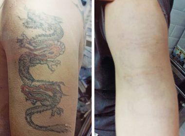 eliminacion de tatuajes con laser
