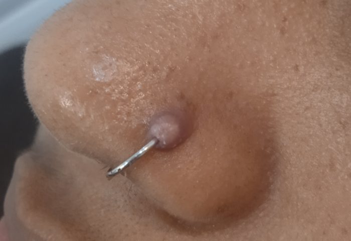 piercing con bulto